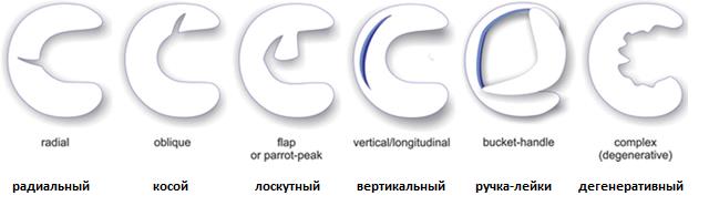 Разрывы мениска по типу 